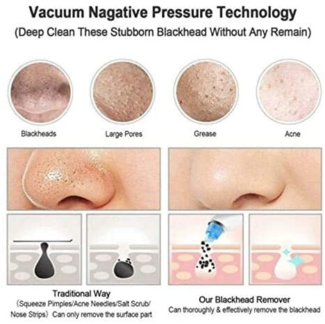 ✨ Blackhead Remover – Vacuum Suction Pore Cleaner for Face