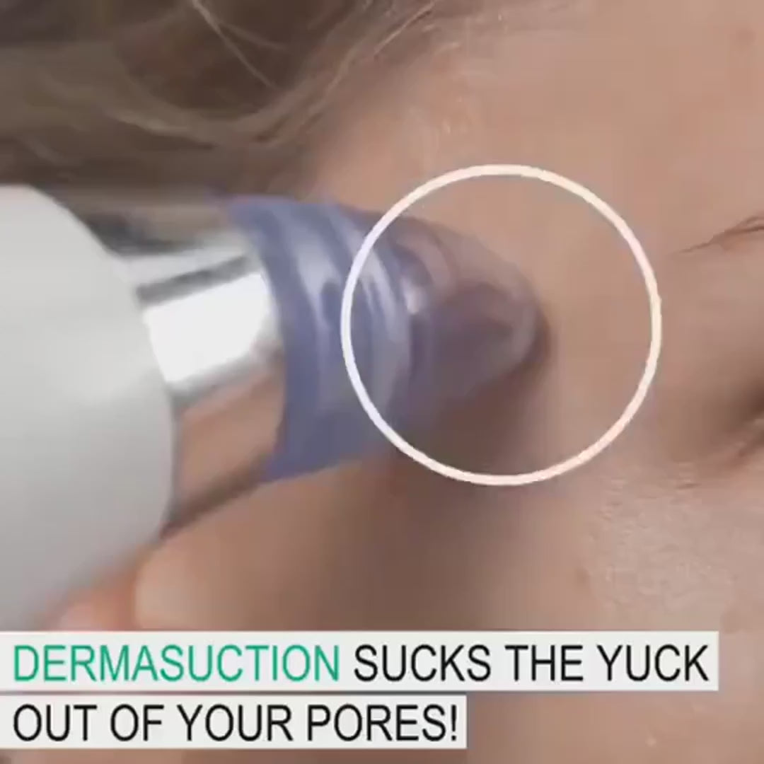 ✨ Blackhead Remover – Vacuum Suction Pore Cleaner for Face